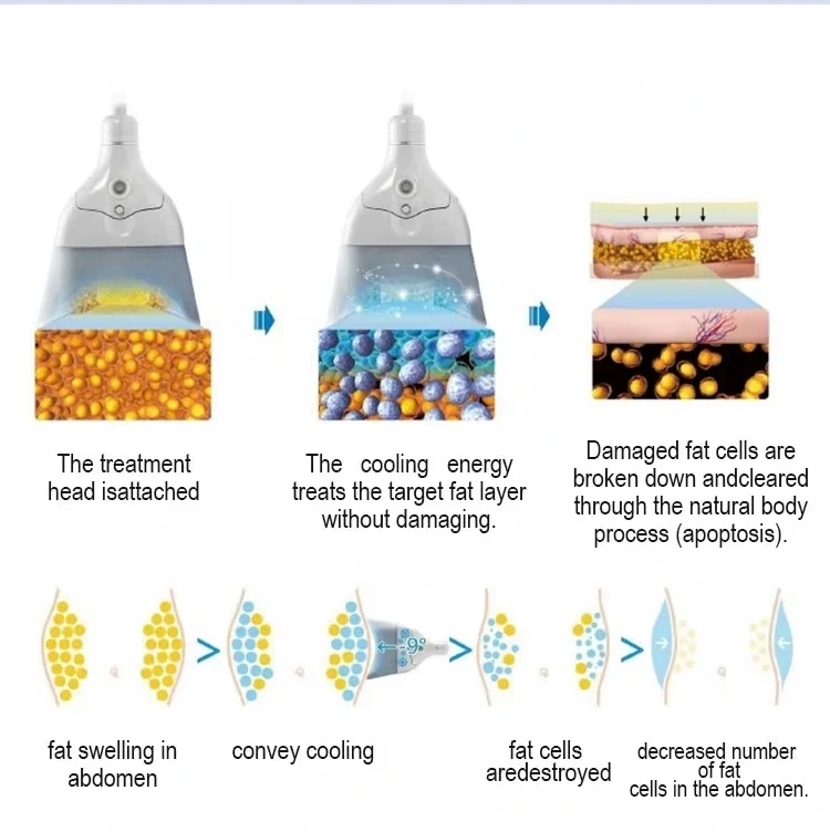 Mediswiss CRYO FAT COOL PRO kryolipolýza